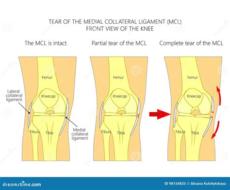 test for medial collateral ligament tear|grade 2 ligament tear knee.